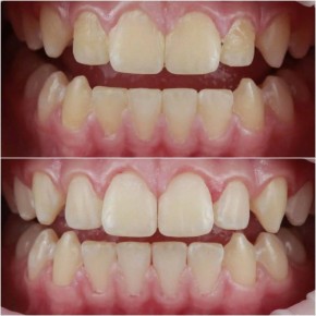 Мягкий зубной налет: невидимая угроза для вашего здоровья